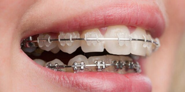 Tipos de ortodoncia