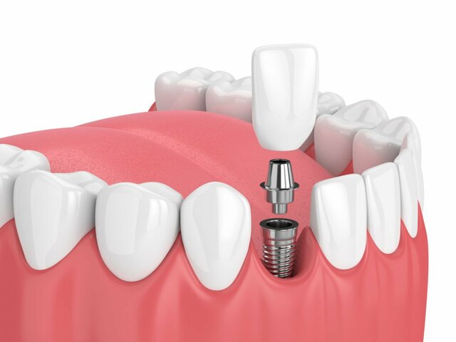 Implantes dentales