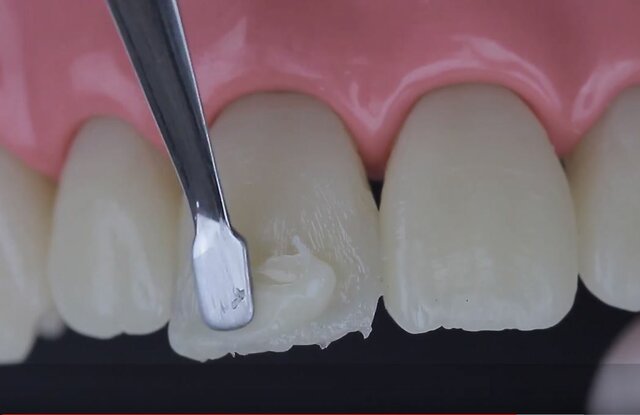 Primera resina compuesta