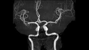 Primera vez el uso de Angiografía