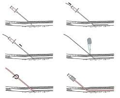 Técnica de Seldiger