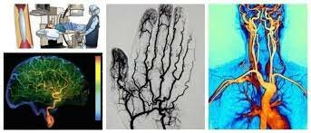 Angiografía Digital