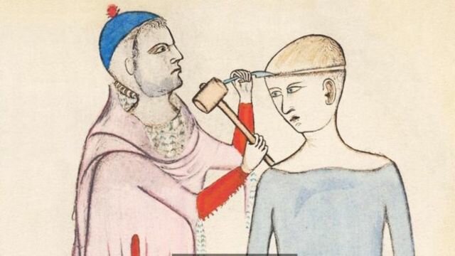 Trepanación