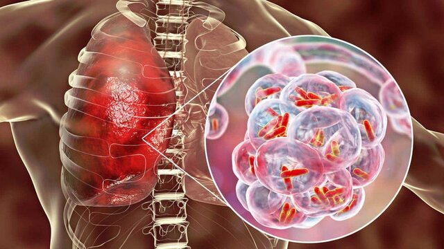 Lanzamiento de la estrategia DOTS para el control de la tuberculosis