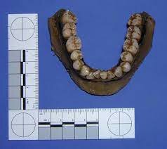 Método Odontometría