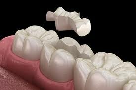 INCRUSTACIONES DE PORCELANA - 1800 a.C.