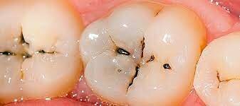 PREVENCION DE LA CARIES - 1815 a.C.