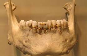 INICIO LA ODONTOLOGIA - 3000 a.C.