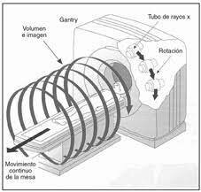 Tomografía computada helicoidal