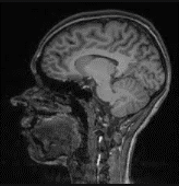 Imagen de resonancia magnética