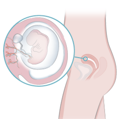 Timeline: Semanas de Gestación.
