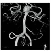 aparición de la angiografía con sustracción digital y reconstrucción tridimensional (ASD-3D), en comparación con otros métodos (Angio TC- AngioRM) permite el control de aneurismas cerebrales clipados o embolizados.
