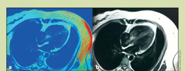 Tomografía Computada Helicoidal