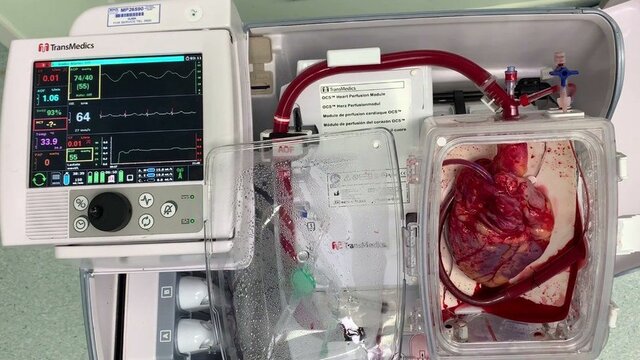 The first non-beating transplant