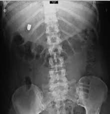 Primera vida que se salva gracias a los rayos X