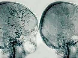 Creación de la angiografía