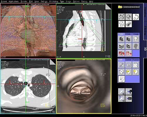 RECONSTRUCION POR COMPUTACION