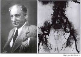 DESCUBRIMIENTO ANGIOGRAFIA