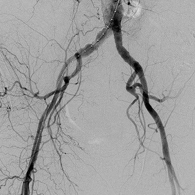 APLICACION DE LA ARTERIOGRAFIA