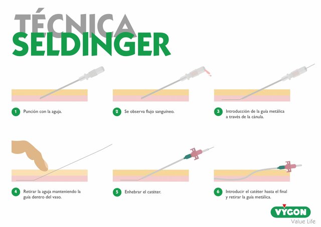TECNICA DE SELDINGER