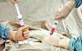 Primer trasplante de la médula ósea.