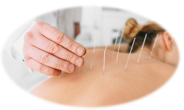 Acupuntura