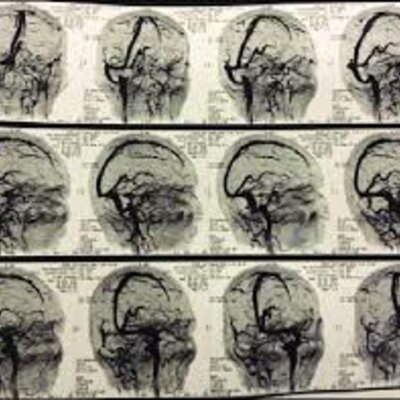 Timeline: LINEA DE TIEMPO SOBRE ANGIOGRAFIA