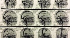 Timeline: LINEA DE TIEMPO SOBRE ANGIOGRAFIA