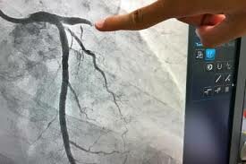 APARECE LA  ANGIOGRAFIA DIGITAL