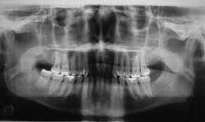 PRIMEROS RAYOS X INTRABUCALES EN PACIENTE VIVO