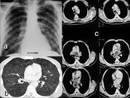 COMITÉ INTERNACIONAL DE PROTECCIÓN RADIOLÓGICA