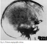 Primera angiografía exitosa. Era un hombre joven de 20 años que tenía un tumor hipofisiario y un síndrome de Babinsky-Fronhlich. En este caso las ramas se definieron claramente en las radiografías.
