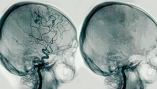 Egas aporto el trabajo de la angiografía cerebral, donde describió las fases arteriales, capilar y el primer y segundo tiempo venoso, describió a las malformaciones arteriovenosas y los aneurismas.