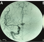 Se presenta la angiografía por sustracción digital por sus siglas ASD, presentado mundialmente en Chicago, usada para visualizar los vasos sanguíneos en zonas óseas o con tejido denso.