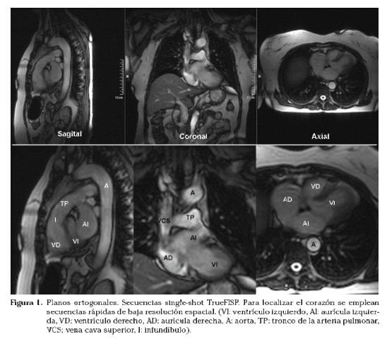 RMN planos como; axiales, coronales, oblicuas y con medios de contraste.