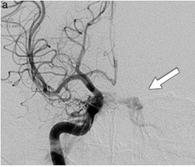 Angiografía cerebral