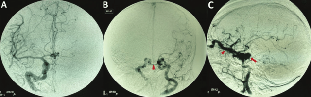 La angiografía con substracción digital reconstrucción tridimensional (ASD – 3D)