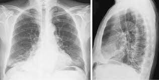 Radiografía de tórax y hueso