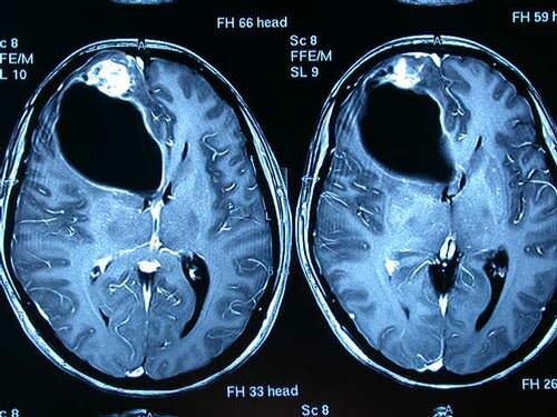 Primera exploración en un paciente utilizando TAC+