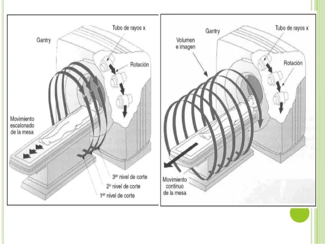 TC secuencia frente a TC helicoidal