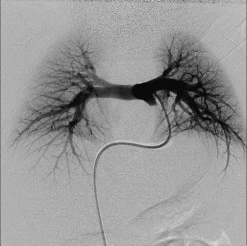 Angiograma pulmonar