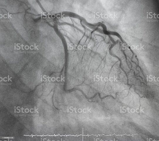 Angiografía coronaria