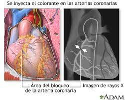 Angioplastia coronaria