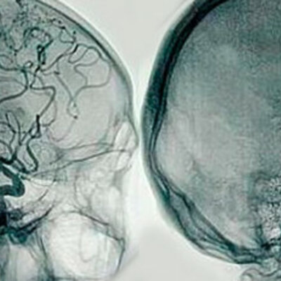 Timeline: Angiografía