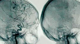 Timeline: Angiografía