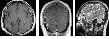 Avances con el Ultrasonido