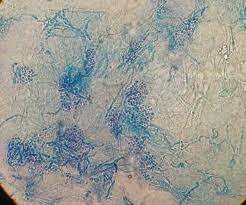 AUG 4, 1846 PITIRIASIS VERSICOLOR