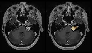 Reconociendo la importancia del descubrimiento de Damadian, el investigador Paul Lauterbur desarrolló la técnica para generar las primeras imágenes en resonancia magnética en 2 y 3 dimensiones utilizando gradientes, y publicó la primera en 1973.