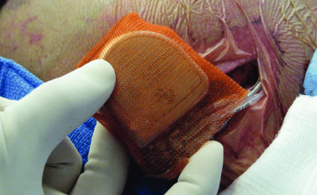 Antibiotic Envelope for Cardiac Implantable Device Infection Prevention