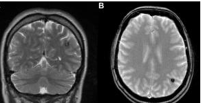 1978 Mansield y Pyket desarrollan la imagen ecoplanar, esto llega a permitir la adquisición de cada dato necesario para poder lograr una reconstrucion de una imagen .